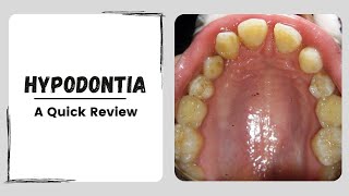 Hypodontia | Oligodontia | Missing Teeth