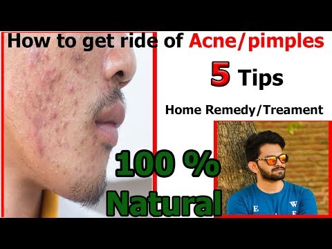 How to get Ride of Acne/Pimple | How to stop bacterial grow of Acne/Pimple | Hindi