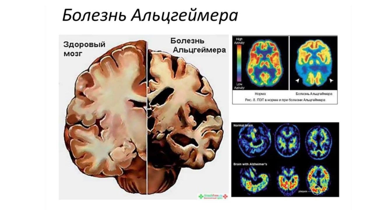 Терминальная деменция. Болезнь Альцгеймера. Синдром Альцгеймера. Поражение головного мозга. Болезнь Альцгеймера мозг.