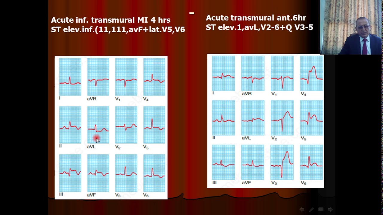 Acute Coronary Syndromes(ACS) Part 2