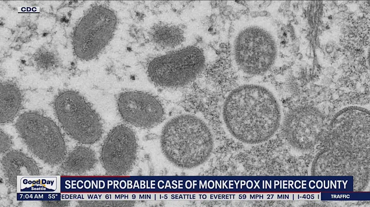 2nd probable case of monkeypox in Pierce County | FOX 13 Seattle