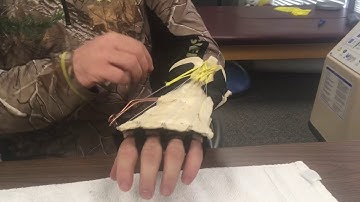 Radial Nerve Palsy dynamic extension functional splint.