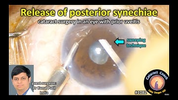 CataractCoach 1082: fixing posterior synechiae during cataract surgery