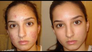 A true miracle- How I got rid of my acne. Daily skin-care routine.(Purchase the exact kit mentioned in video here: http://go.magik.ly/r/mamichula/d629/ (NOT SPONSORED) So the acne.org system worked great for my sister, ..., 2011-12-08T00:12:22.000Z)