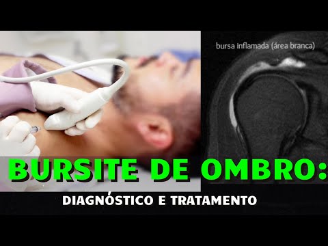 Vídeo: Como tratar a bursite subacromial