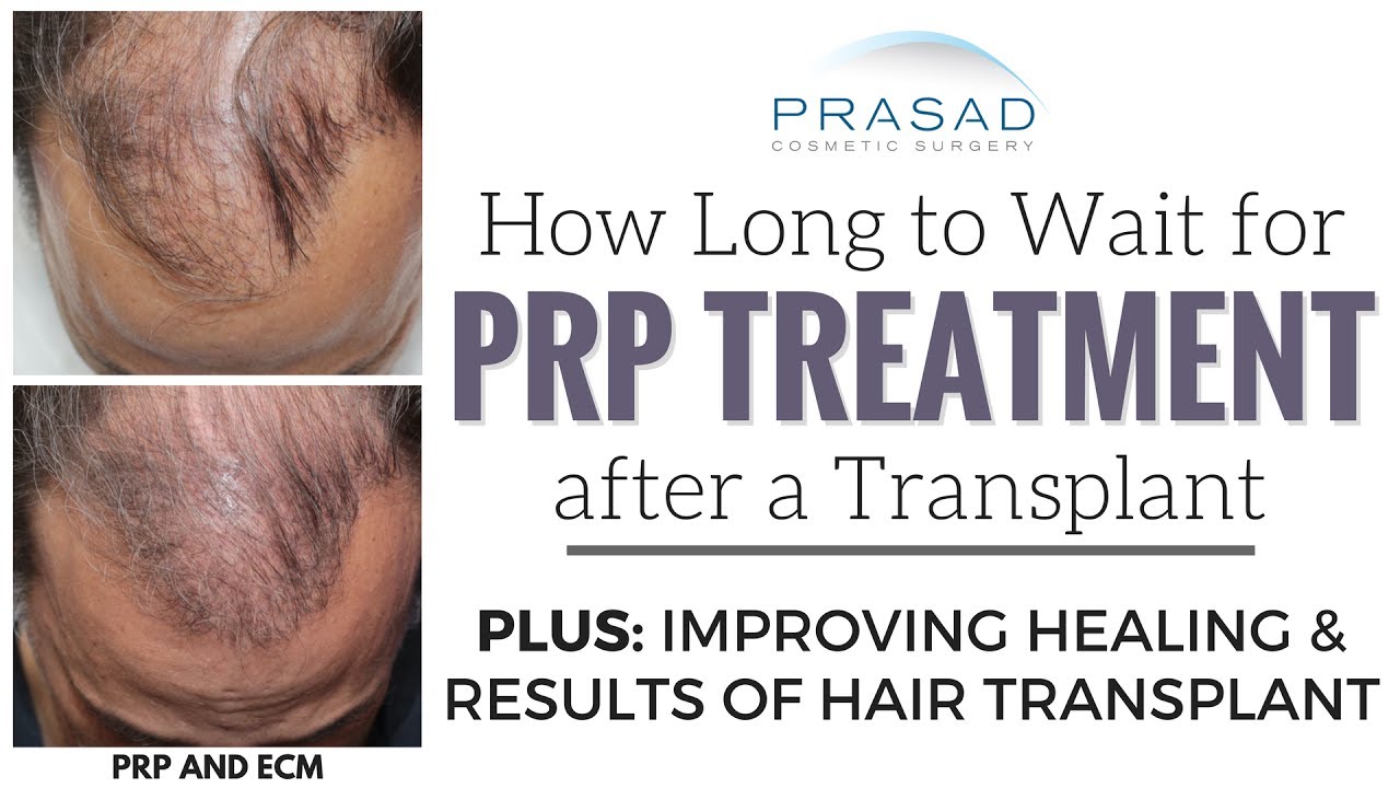 Safe Timing of PRP Scalp Injections After a Hair Transplant, and a Single  Treatment PRP Combination - YouTube
