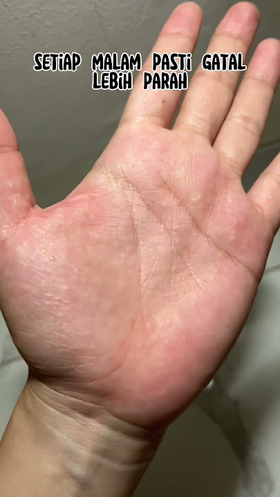 Download lagu Ada yang pernah ngalamin? Obatnya cuma Sabar • Yuk bisa tanpa minum obat‼️ #berbagiinfo #eksim