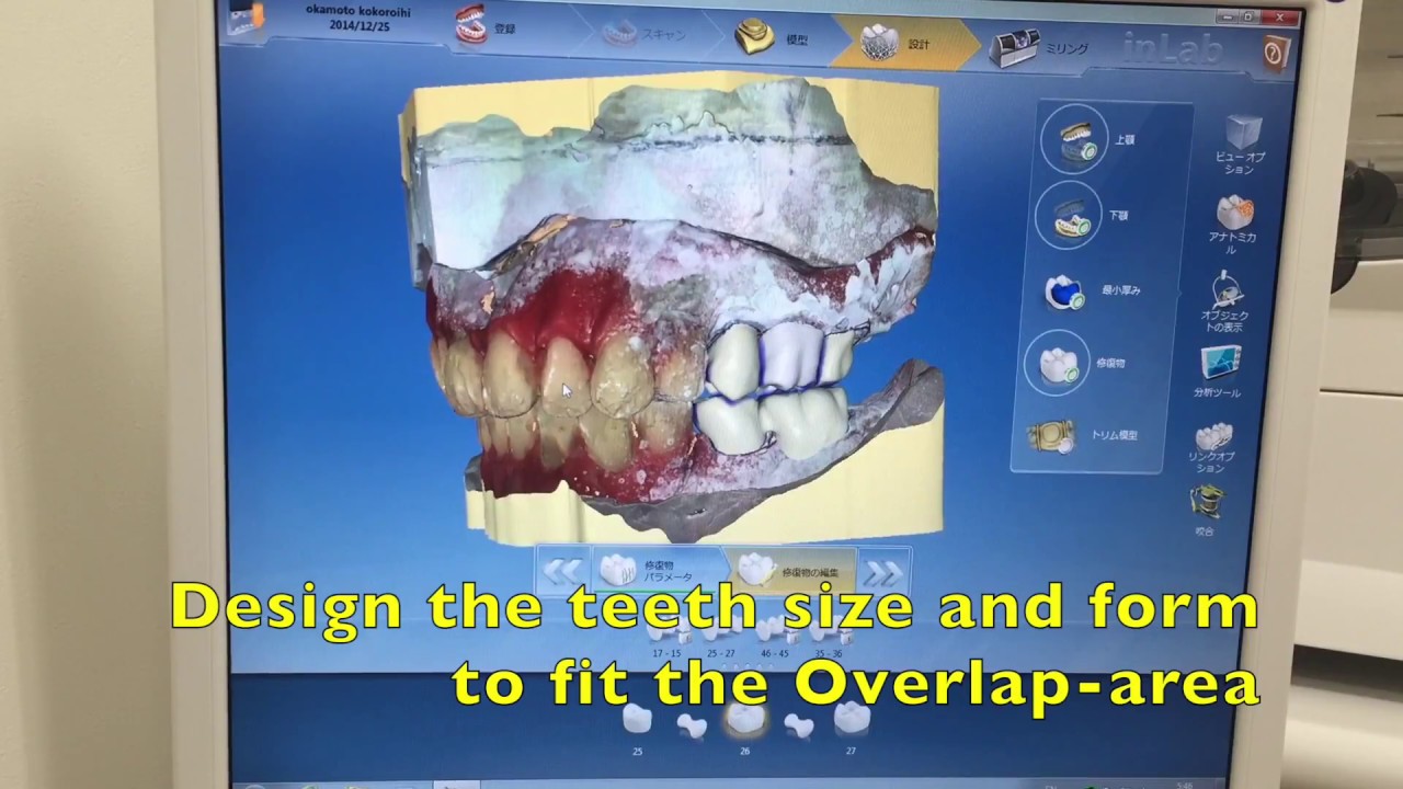 CAD/CAM Posterior teeth -OM Denture System- - YouTube