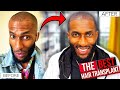 The BEST Black-Afro Hair Transplant in the WORLD! | COOPSCORNER