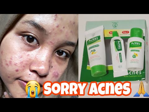 Cara Cepat Menghilangkan Jerawat !! -Skincare Rutin. 