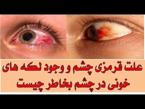 Persian Top Tube علت دیده شدن لکه های خونی در چشم چیست
