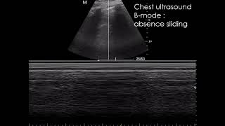 CASE 983 ultrasound pneumothorax