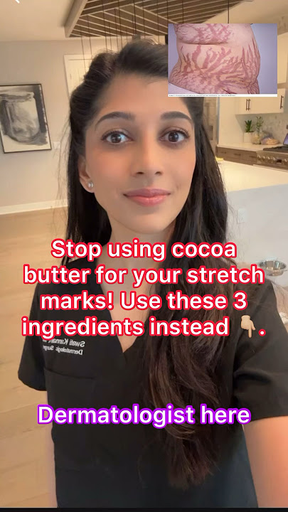 Stop Using Cocoa Butter for Stretch Marks. Use THIS Instead