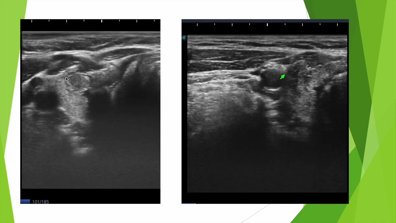 Nodule TIRADS 5 en échographie