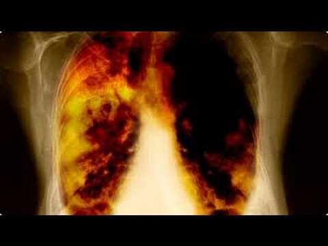 lung cancer pathophysiology - YouTube