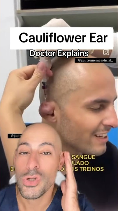 Cauliflower Ear DRAINED! #shorts