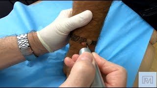 Détatouage Laser Au Centre Pmlaser À Paris