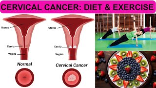 Diet & Exercise Secrets to Fight Cervical Cancer! by Research Your Food 262 views 3 months ago 3 minutes, 47 seconds