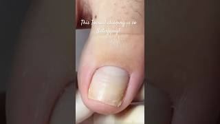 Can You Watch This Toenail Fix Without Looking Away?