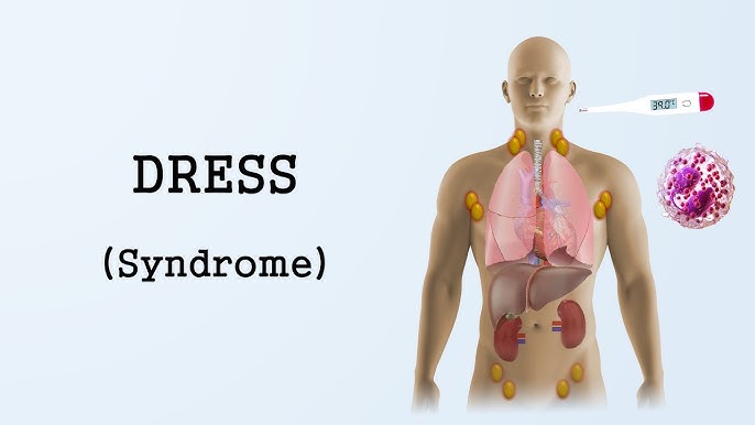 Agosto 2019 - Sindrome Dress: A propósito de un caso. 