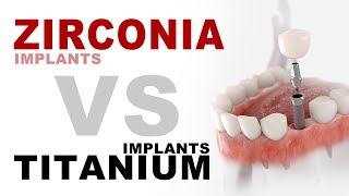 Zirconia Implants VS Titanium Implants | Aria Dental | Maryam Horiyat DDS.