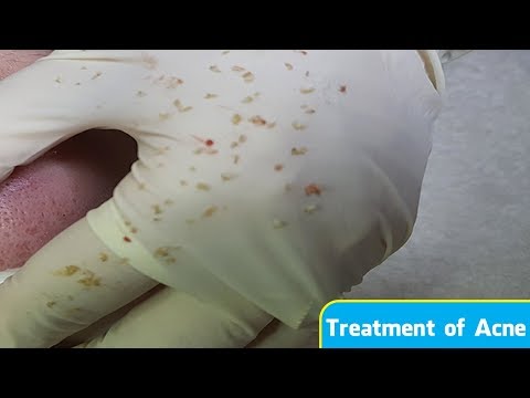 Điều trị mụn ẩn - mụn cám hiệu quả | Treatment of acne | . Tại Hiền Vân Spa - bài 200