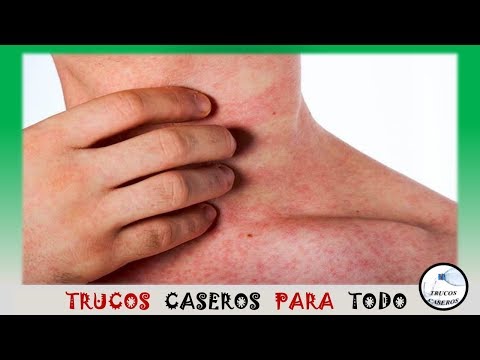 Vídeo: Calor Espinoso: Tratamiento Del Calor Espinoso Con Remedios Y Métodos Caseros