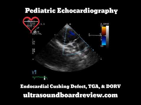 Video: Kako upotrijebiti endocardial u rečenici?