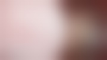 Supraclinoid ICA Dolichoectasia Causing Compression of the Optic Nerve