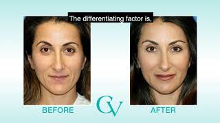 Facial Fat Transfer by Plastic Surgeon Dr. Amir Karam