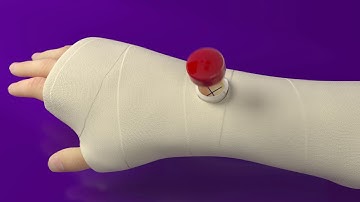 Exogen All Installations