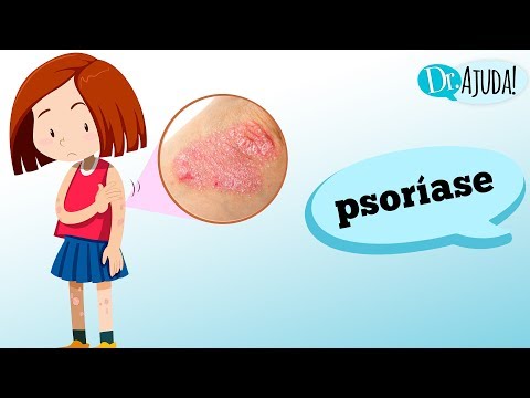 Vídeo: É Urticária Ou Psoríase? Aprenda Os Sinais