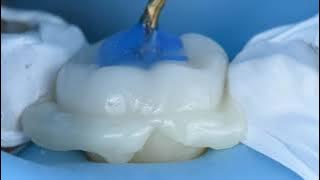 CERAMIC EMAX OVERLAY - All steps and all tips and trick from prep to delivery