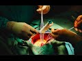 Open Heart Surgery: Aortic Root and Valve Replacement (Bentall Procedure)