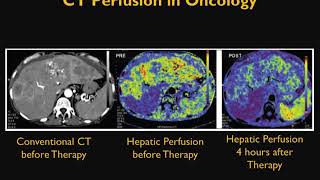 CT Perfusion