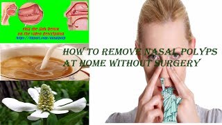 How To Treat Nasal Polyps Without Surgery   Natural Home Treatment For Nasal Polyps