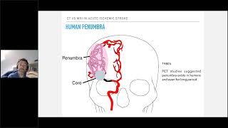 Rural Update for Stroke – Hyperacute Interventions RUSH IN