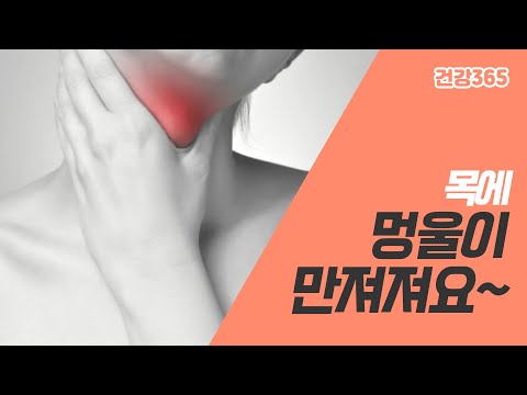 목에 멍울이 만져져요~ [TBC클리닉건강365]