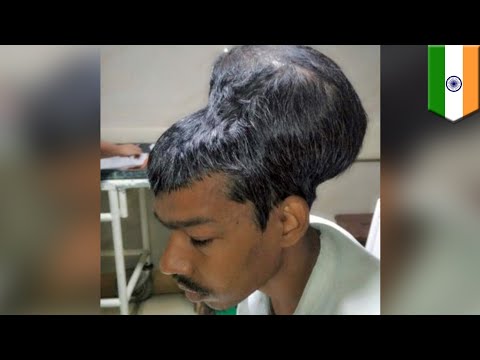 Video: Orang India Menyingkirkan Tumor Rahang Atas Terbesar Di Dunia 18+ - Pandangan Alternatif
