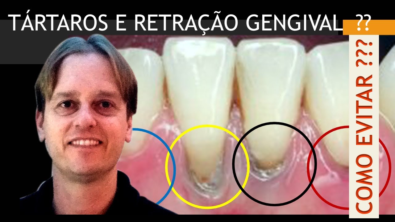 Tenho Retração Gengival e Tártaro Nos Dentes - Técnica Ninja 2.0 Para  EVITAR EM CASA !