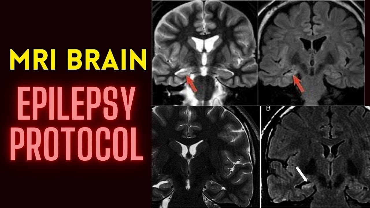 MRI Brain Epilepsy Protocol Planning YouTube MRI Brain Epilepsy Protocol Planning YouTube