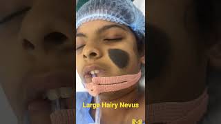 Huge Hairy Nevus Mole Staged Removal to Prevent Facial Dis figurement