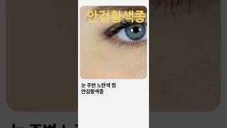 #안검황색종   어떻게 치료해야할까?