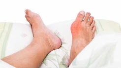 Difference Between Gout and Arthritis