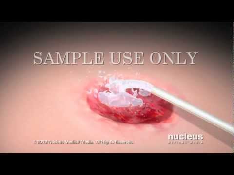 Vídeo: Per què l'epidermis està afectada per l'úlcera de decúbit?