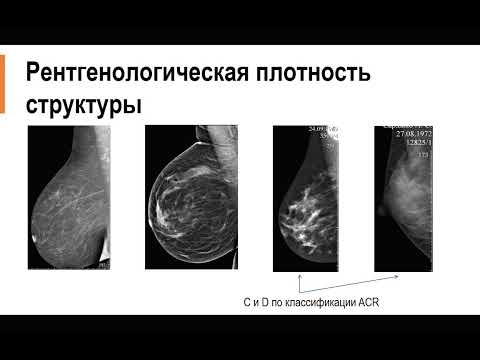 МАММОГРАФИЯ Лекция «Скрининг рака молочной железы»