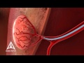 Uterine Fibroid Embolization (UFE) - 3D Medical Animation