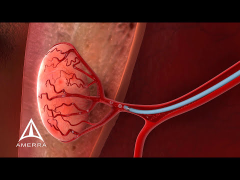 Uterine Fibroid Embolization (UFE) - 3D Medical Animation