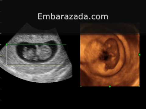 10 semanas de embarazo ecografia 3d 10 semanas de embarazo ecografia 3d