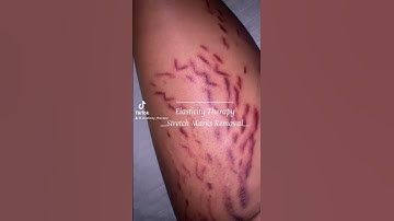 stretch marks treatment #stretchmarks #stretchmarksremoval